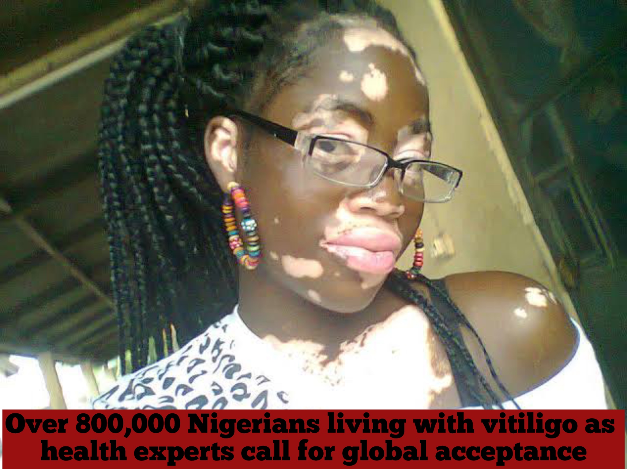 Over 800,000 Nigerians living with vitiligo as health experts call for global acceptance